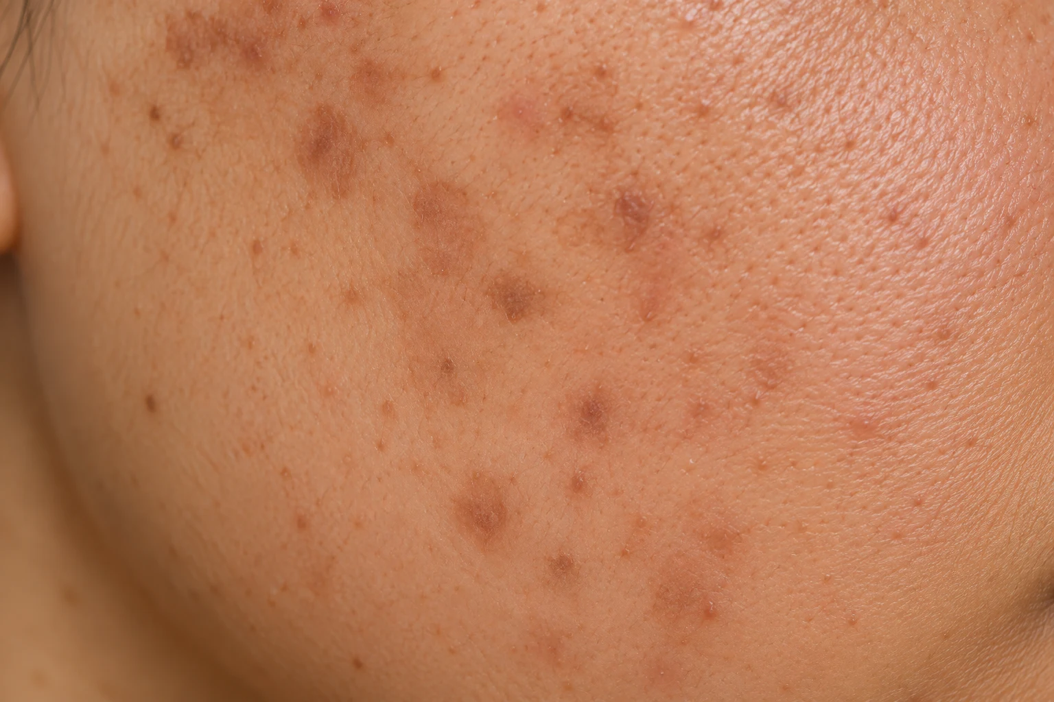 Close-up of cheek skin with pigmentation and dark marks