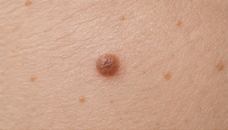 A raised, rounded brown benign mole
