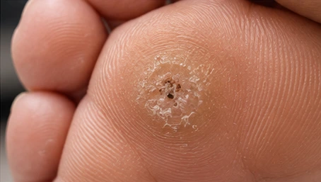 A verruca on the sole of the foot