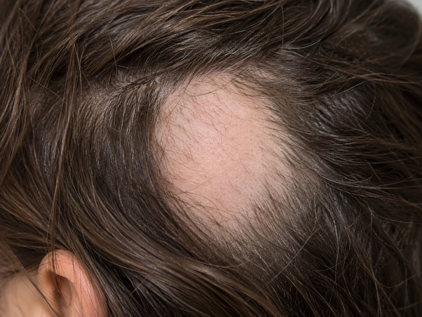 Close-up of a patch of hair loss on the scalp associated with alopecia areata