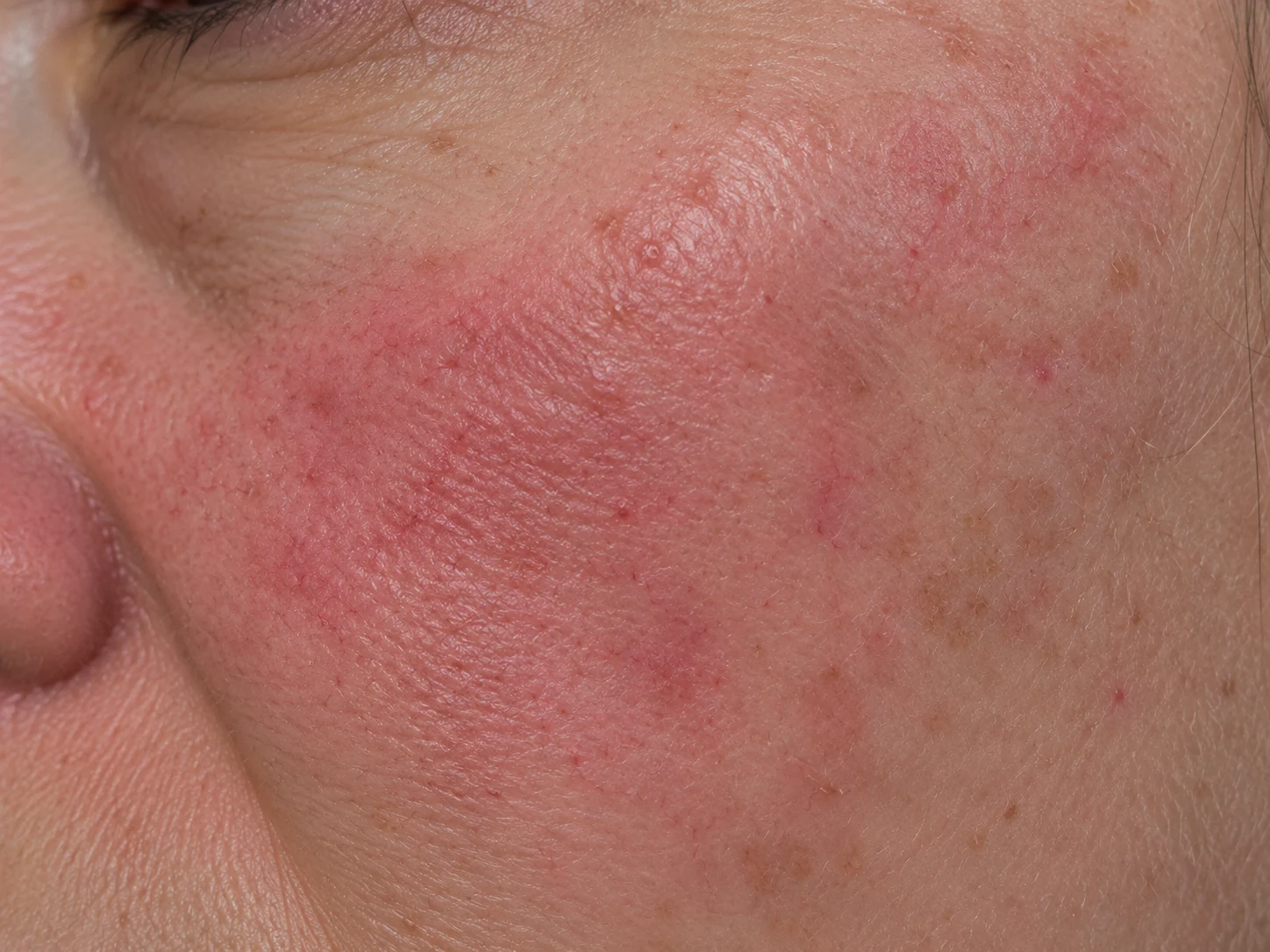 Rosacea