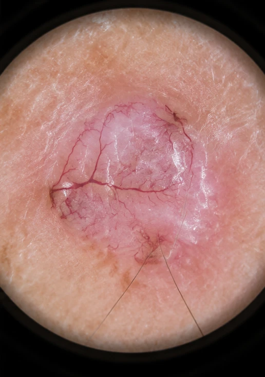 Close-up of a basal cell carcinoma showing prominent surface blood vessels